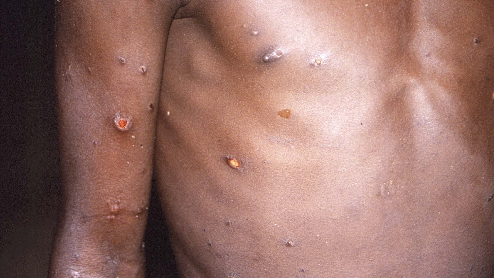 Les symptômes de cette infection sont des lésions cutanées et aux organes génitaux.