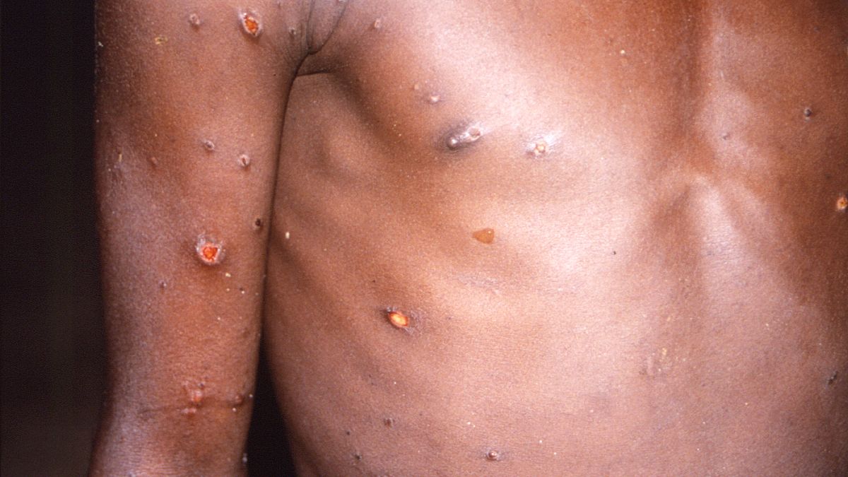 Une image d'un patient atteint de la variole simienne en 1997.