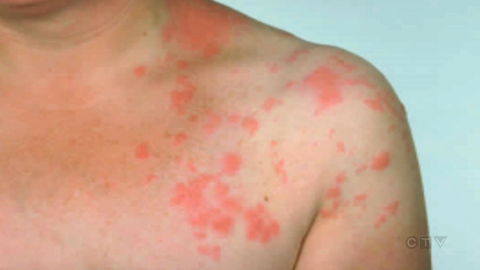Dans de rares cas, le virus varicelle-zona peut également provoquer un trouble neurologique connu sous le nom de syndrome de Ramsay-Hunt.