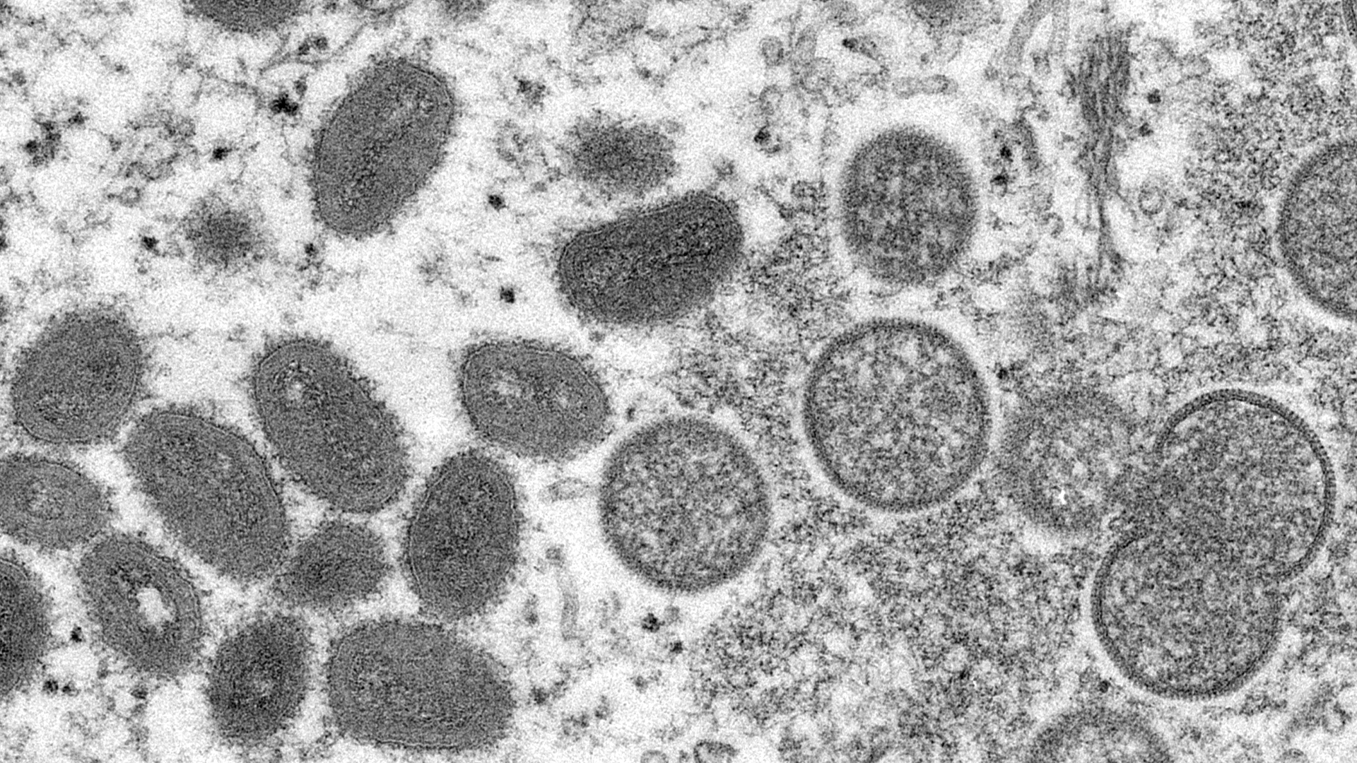 Les cas de variole simienne ont triplé au cours des deux dernières semaines en Europe.