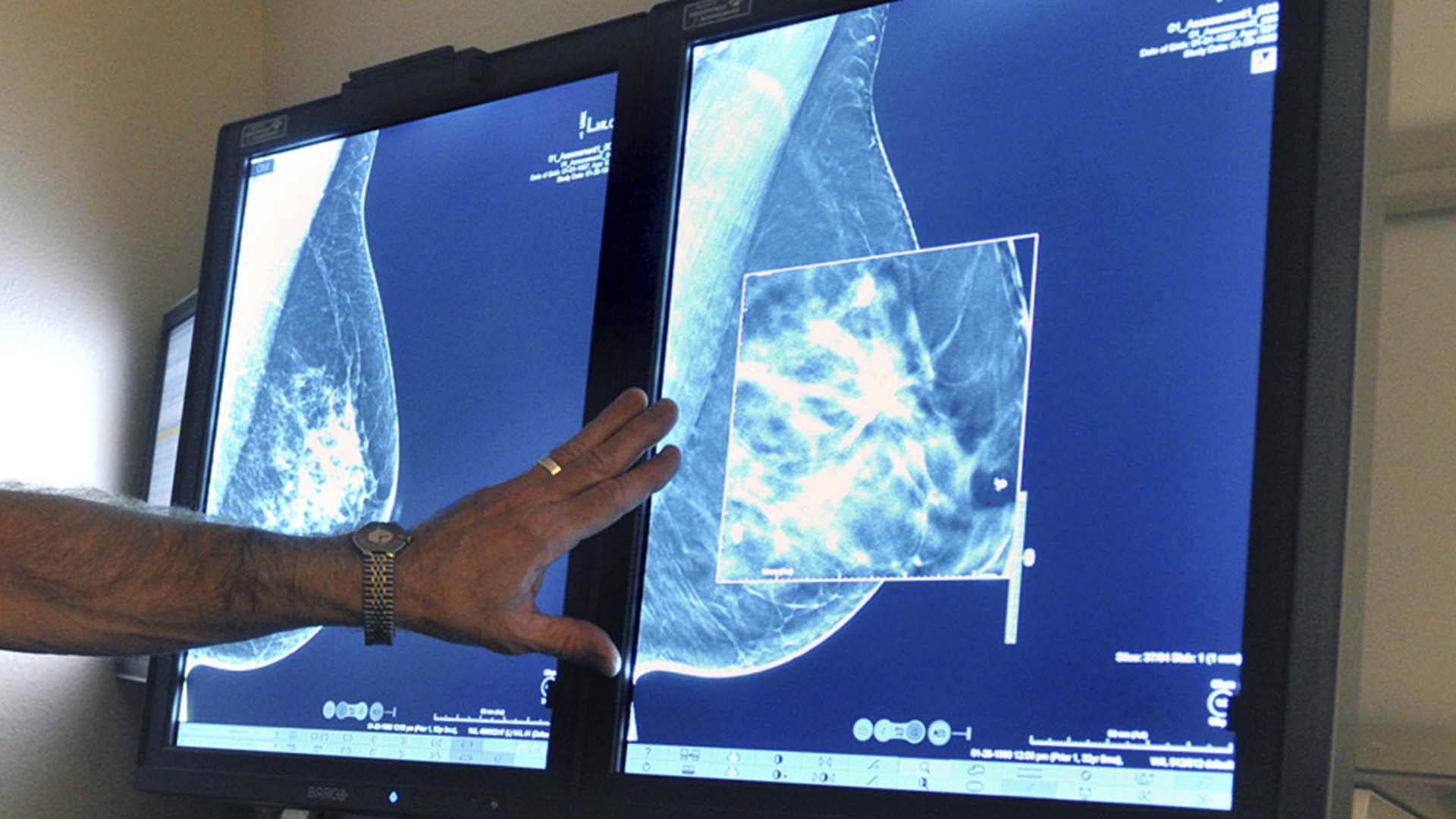 La proportion de cancers du sein avancés chez les femmes de 50 à 59 ans est moins élevée dans les provinces où on effectue des mammographies annuelles chez les 40 à 49 ans que dans les provinces qui commencent le dépistage plus tardivement.