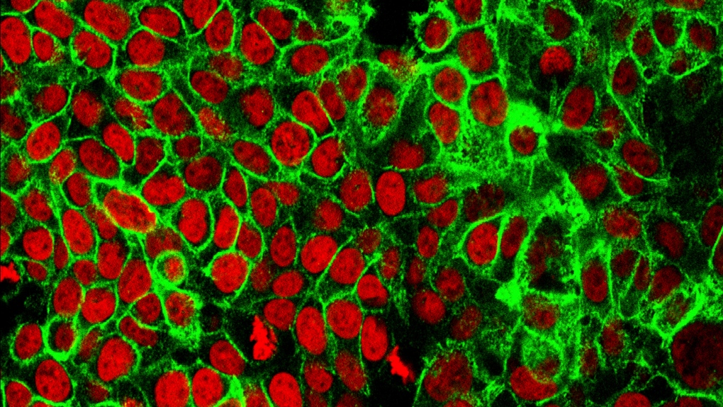 Cette image au microscope mise à disposition par le National Cancer Institute Center for Cancer Research en 2015 montre des cellules cancéreuses du côlon humain avec les noyaux colorés en rouge.