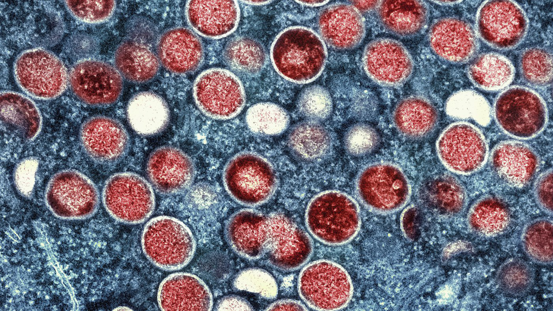 L'agence onusienne a annoncé lundi dans un communiqué que le nom «mpox» serait adopté pour désigner la variole simienne