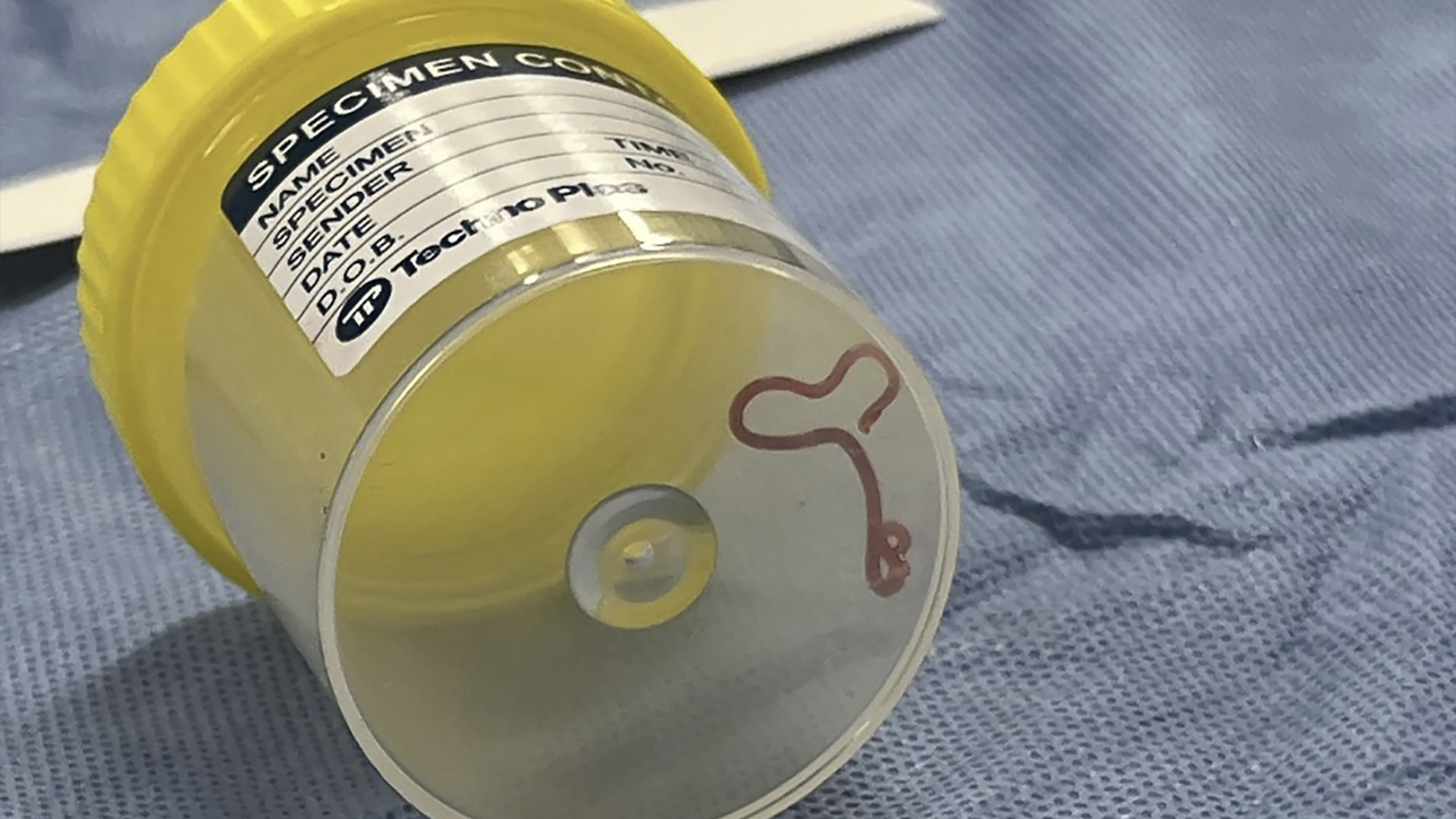 Cette photo fournie par les Services de santé de Canberra montre un parasite dans un bocal d'échantillon dans un hôpital en Australie.  