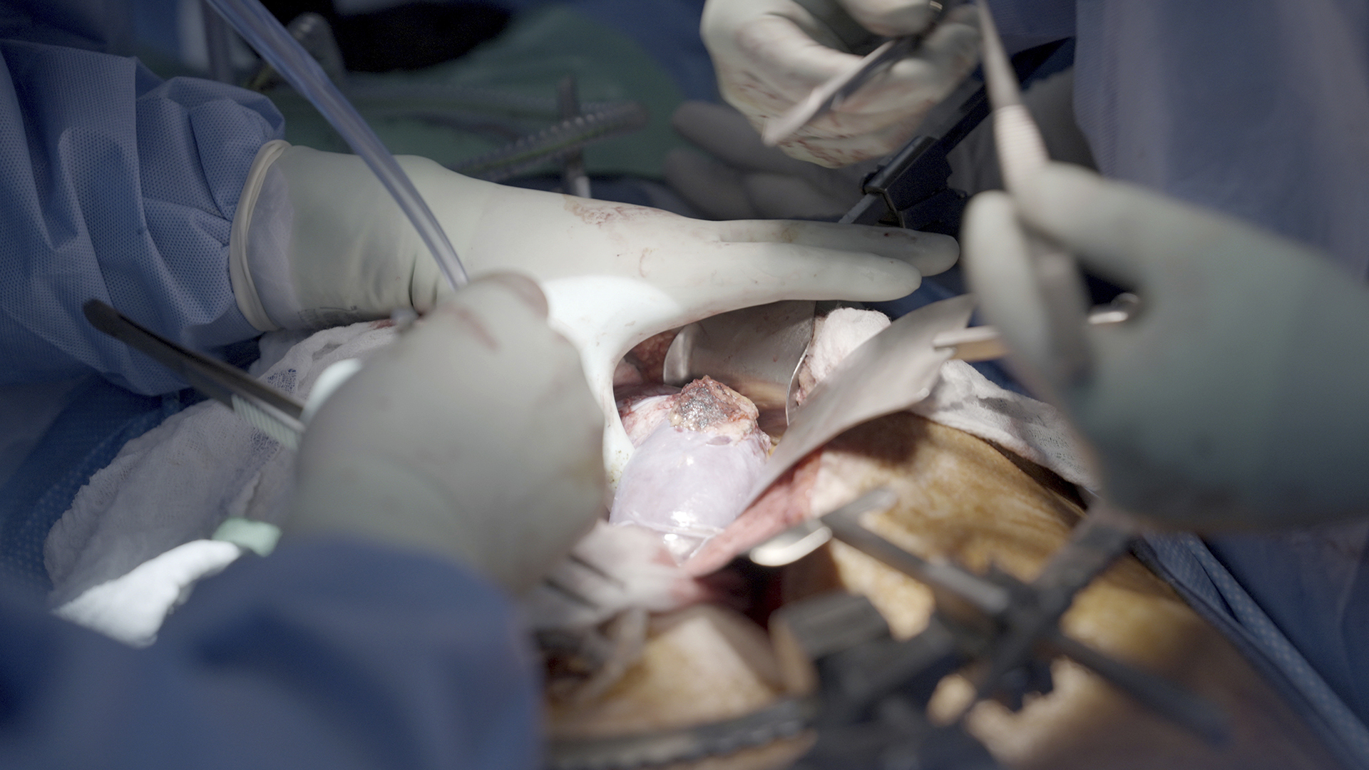 Un riñón de cerdo funciona durante dos meses en el cuerpo humano, lo que supone un récord