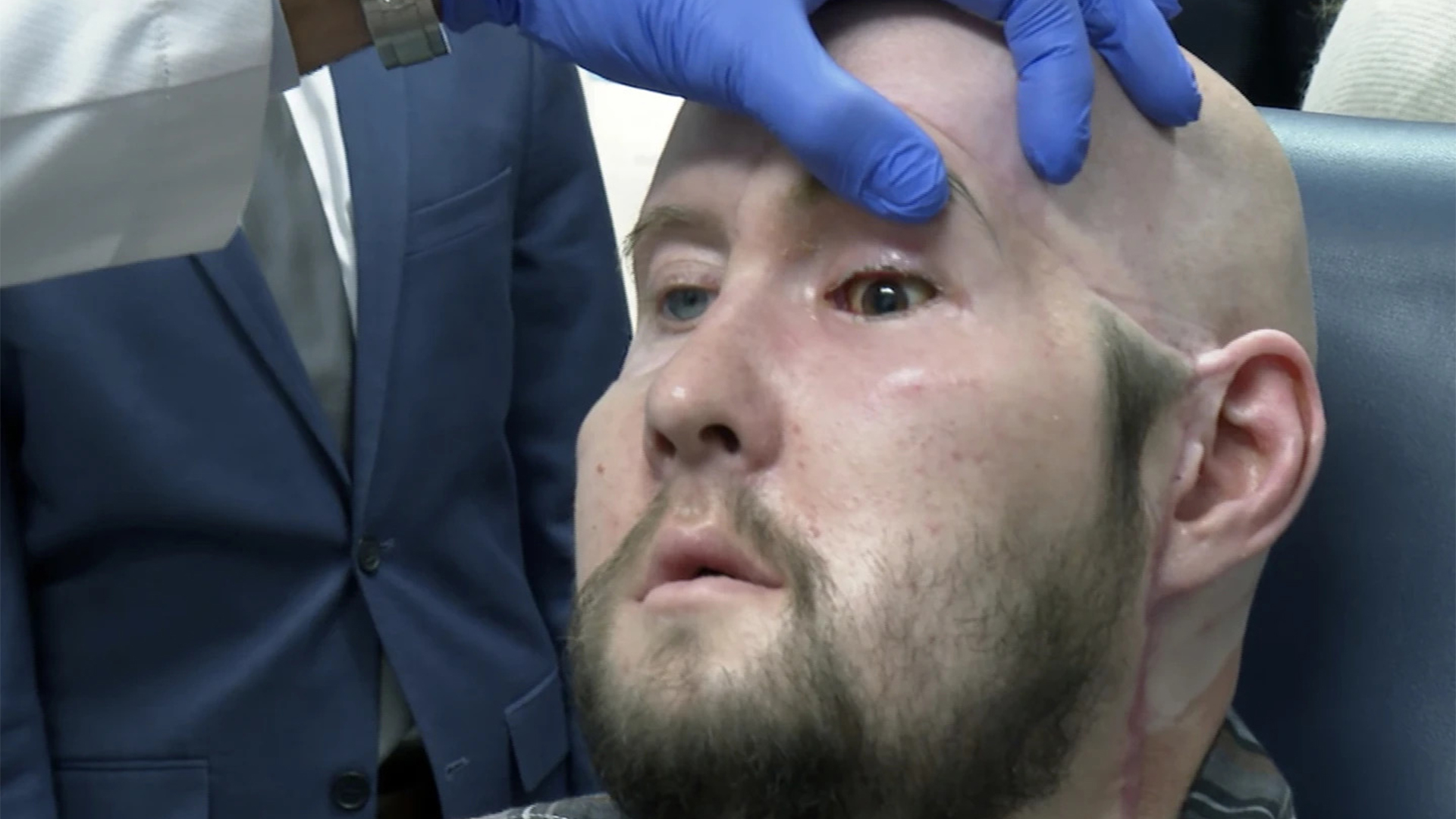 Sur la photo, le patient Aaron James reçoit la première greffe au monde d'un œil humain entier.