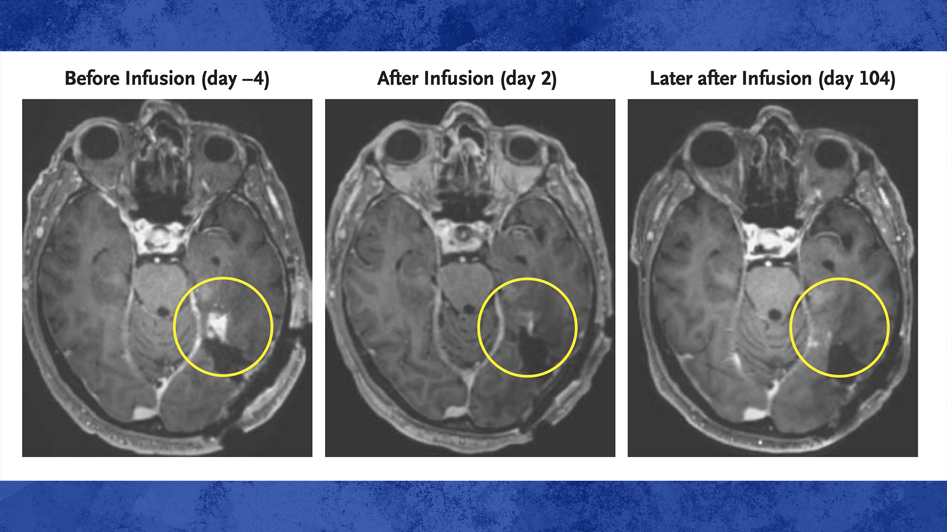 Cette combinaison d'images IRM fournie par le New England Journal of Medicine en mars 2024 montre les progrès d'un patient atteint d'un glioblastome ayant reçu une thérapie CAR-T qui utilise des versions modifiées des cellules T du système immunitaire du patient.