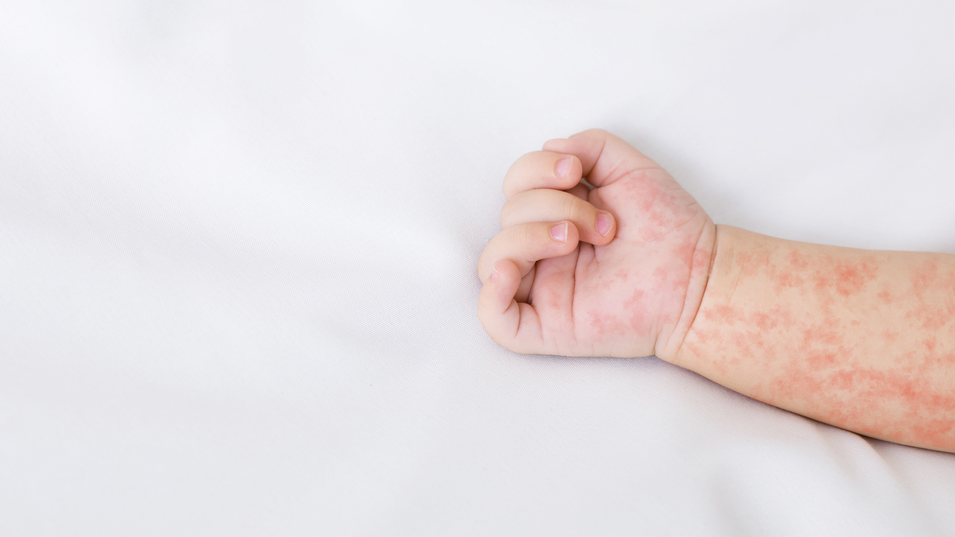 At least five cases of measles have been reported in Estrie