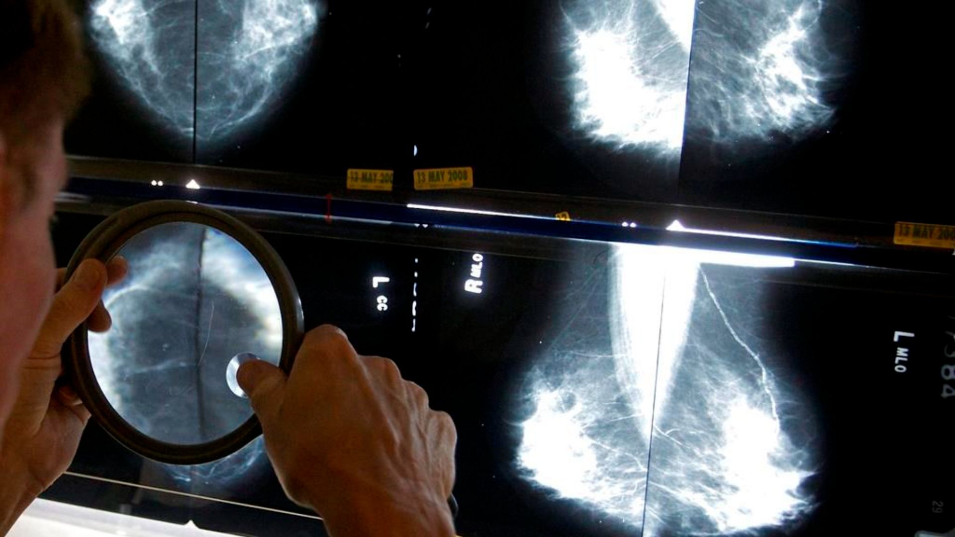 Canadian Cancer Society calls for breast cancer screening starting at age 40