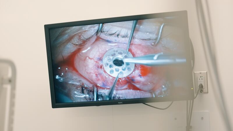 La Dre Dagher implante la kératoprothèse dans l'oeil du patient.