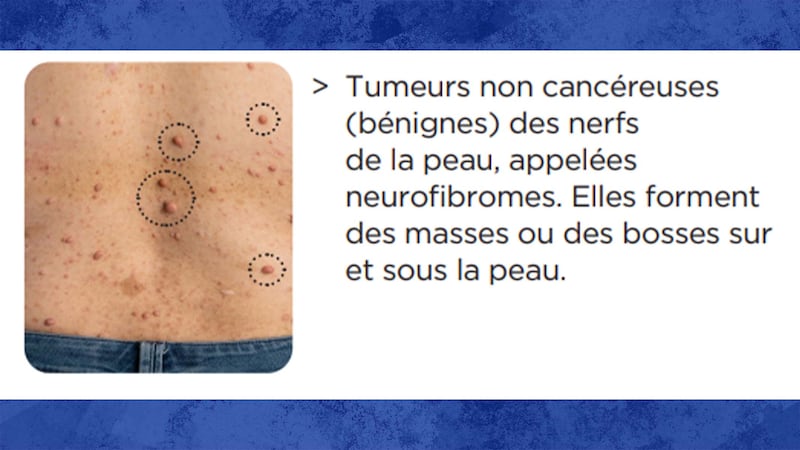 Une image tirée de la fiche explicative du CHUM sur la neurofibromatose (NF1 -Centre de littératie en santé du CHUM) montre des neurofibromes sur le corps d’une personne.