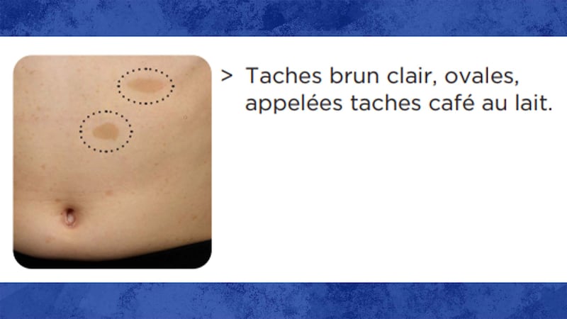 Une image tirée de la fiche explicative du CHUM sur la neurofibromatose (NF1 -Centre de littératie en santé du CHUM) montre des tâches «café au lait» sur le corps d'un enfant.