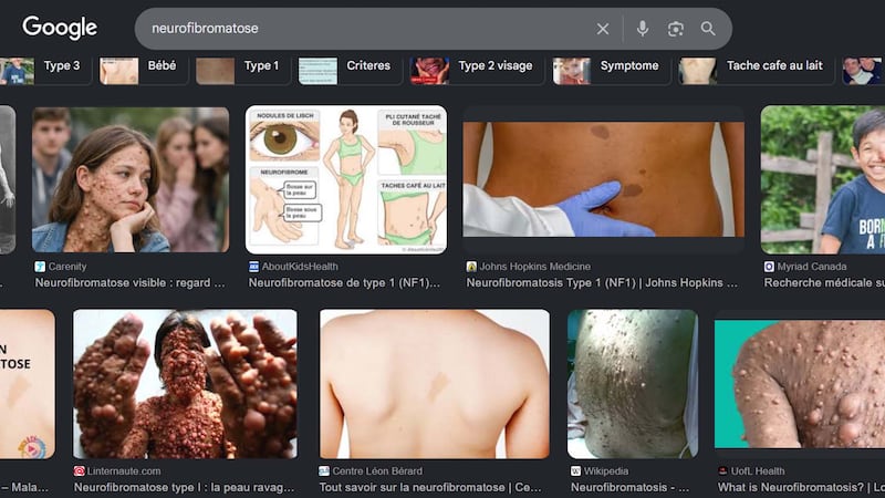 Une recherche Google menée par Noovo Info sur la neurofibromatose le 27 mai dernier mène effectivement sur des images qui peuvent surprendre et inquiéter des parents à qui l'on annonce un tel diagnostic. Selon Jade Pauzé, il s’agit de cas rares qui ne représentent pas du tout la majorité des cas de NF1.