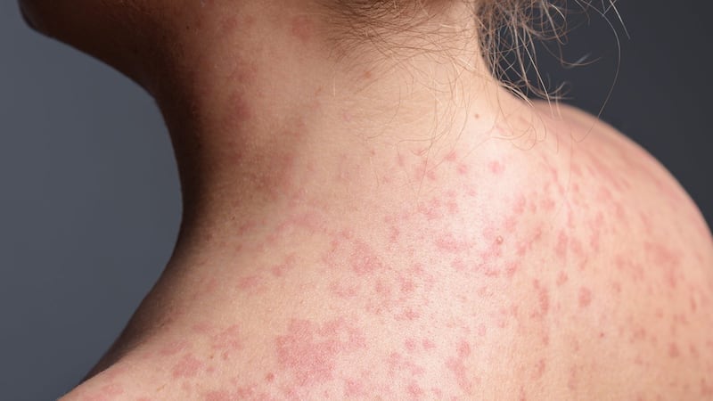 Un cas de rougeole déclaré à Montréal