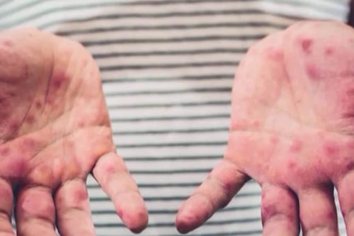 Premier cas de rougeole confirmé dans la région de la Capitale-Nationale