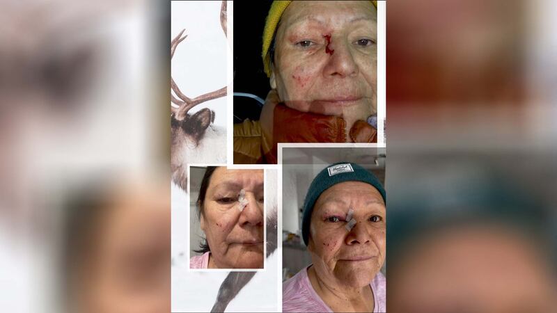 MarieRose Pietacho-Selma a publié une photo de sa mère sur les réseaux sociaux alors que cette dernière aurait été blessée lors d'une intervention des agents de la faune sur le territoire de la communauté d'Ekuanitshit sur la Côte-Nord, le lundi 23 février 2026.