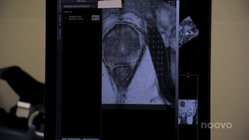 Une percée dans la détection du cancer de la prostate au CHU-Fleurimont