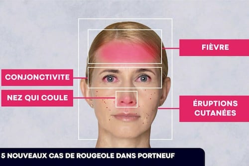 De nouveaux cas de rougeole dans Portneuf